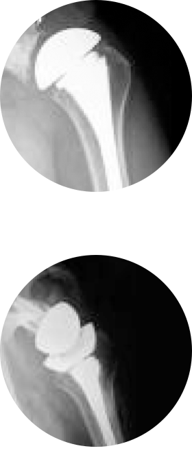 Shoulder Osteoarthritis Treatment